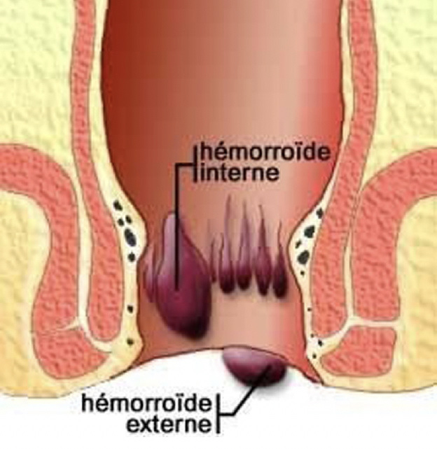Hemorroides internes : comment les détecter ? 